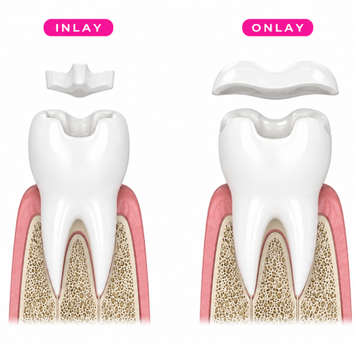 Inlay Onlay